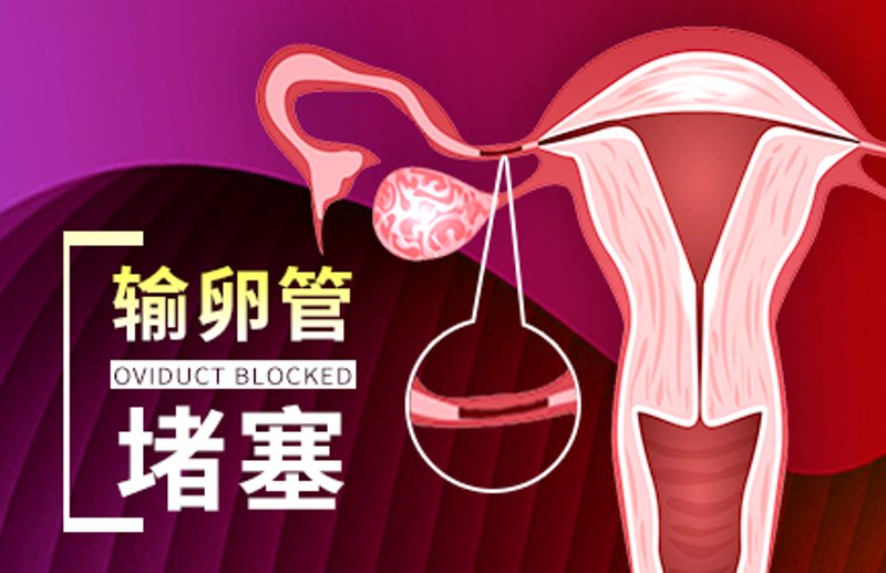 输卵管堵塞：女性生育障碍的隐秘挑战